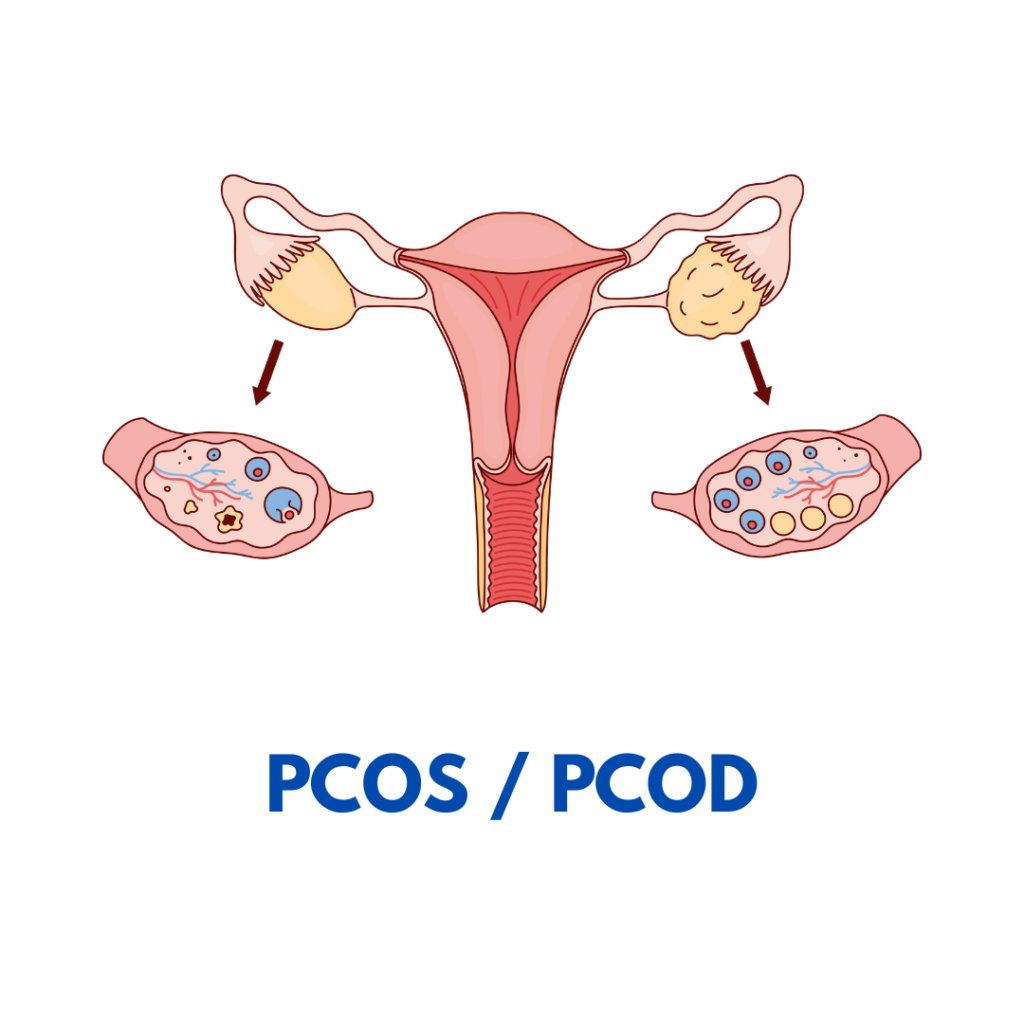 PCOS treatment with homeopathy services Nipani – Dirghayu Health