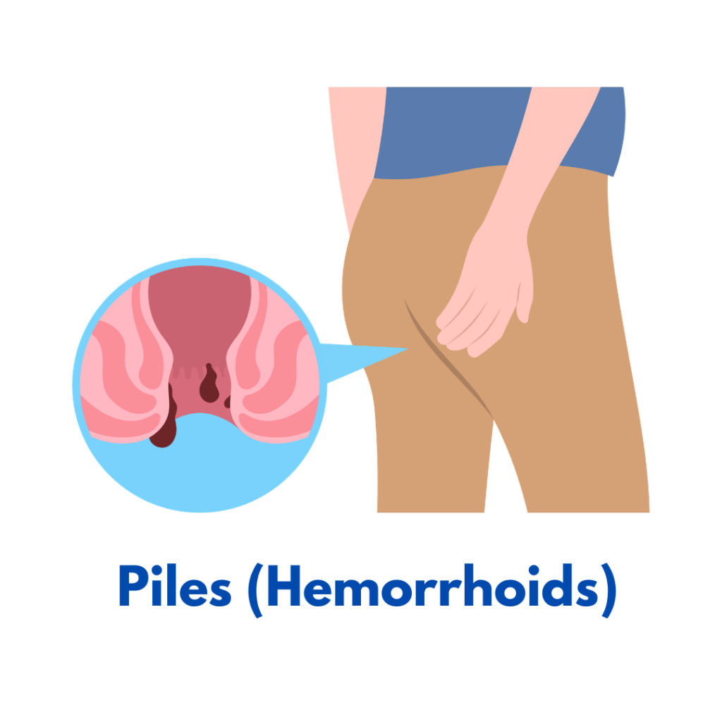 Piles homeopathy treatment for hemorrhoids and pain relief