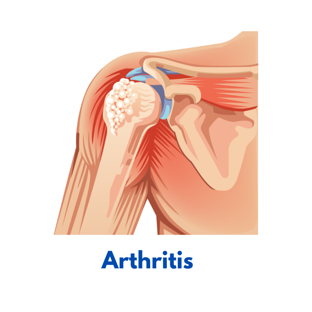 Arthritis homeopathy treatment for joint pain and stiffness