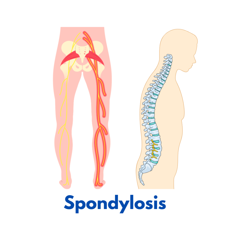 Spondylosis homeopathy treatment for neck and spine pain