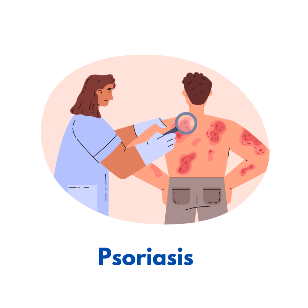 Psoriasis homeopathy treatment for skin inflammation and itching